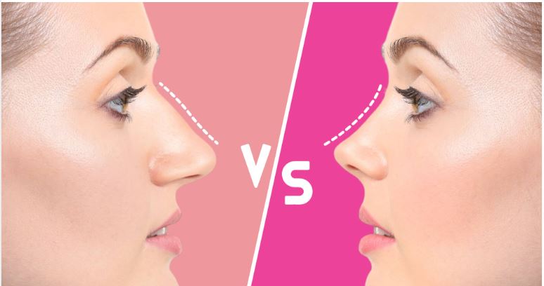 Illustration d'un nez fin obtenu par rhinoplastie ultrasonique (Barbie Nose)