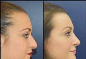 chirurgie de rhinoplastie