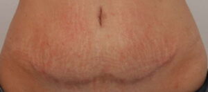 abdominoplastie cicatrice