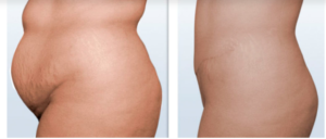 Abdominoplastie mommy makeover tummy tuck grossesse