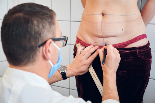 abdominoplastia turquia