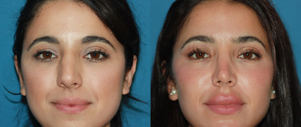 rhinoplastie ultrasonique avant/apres